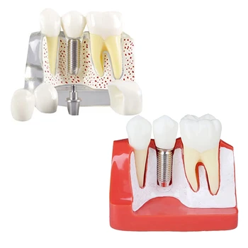 שיניים הדגמה במודל שתל נשלף ניתוח הכתר, הגשר על -מטופל תקשורת